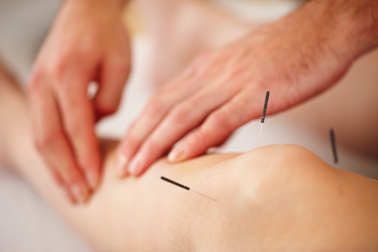How acupuncture relieves pain